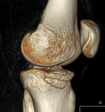Knee dislocation tibial plateau fracture